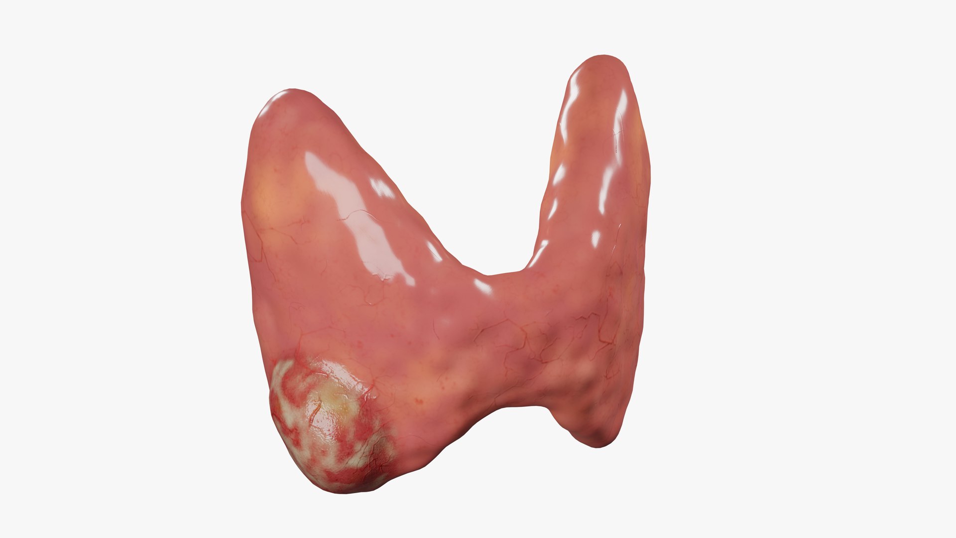 Thyroid cancer 3D model https://p.turbosquid.com/ts-thumb/fm/wbsh8p/Jt/01/png/1648834756/1920x1080/fit_q87/111e3ae856b2fec1084a47eed21c9ccd8e85bc9c/01.jpg