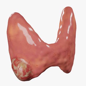 Thyroid cancer 3D model
