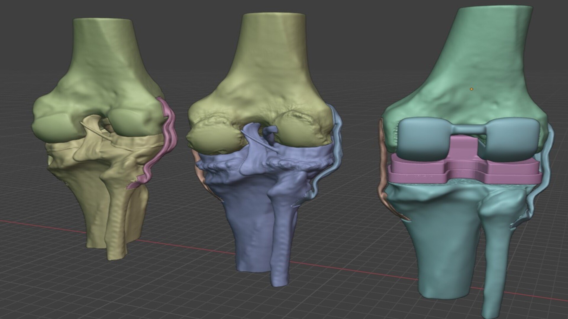 Modular 3D Knee Study Model Model - TurboSquid 2536450