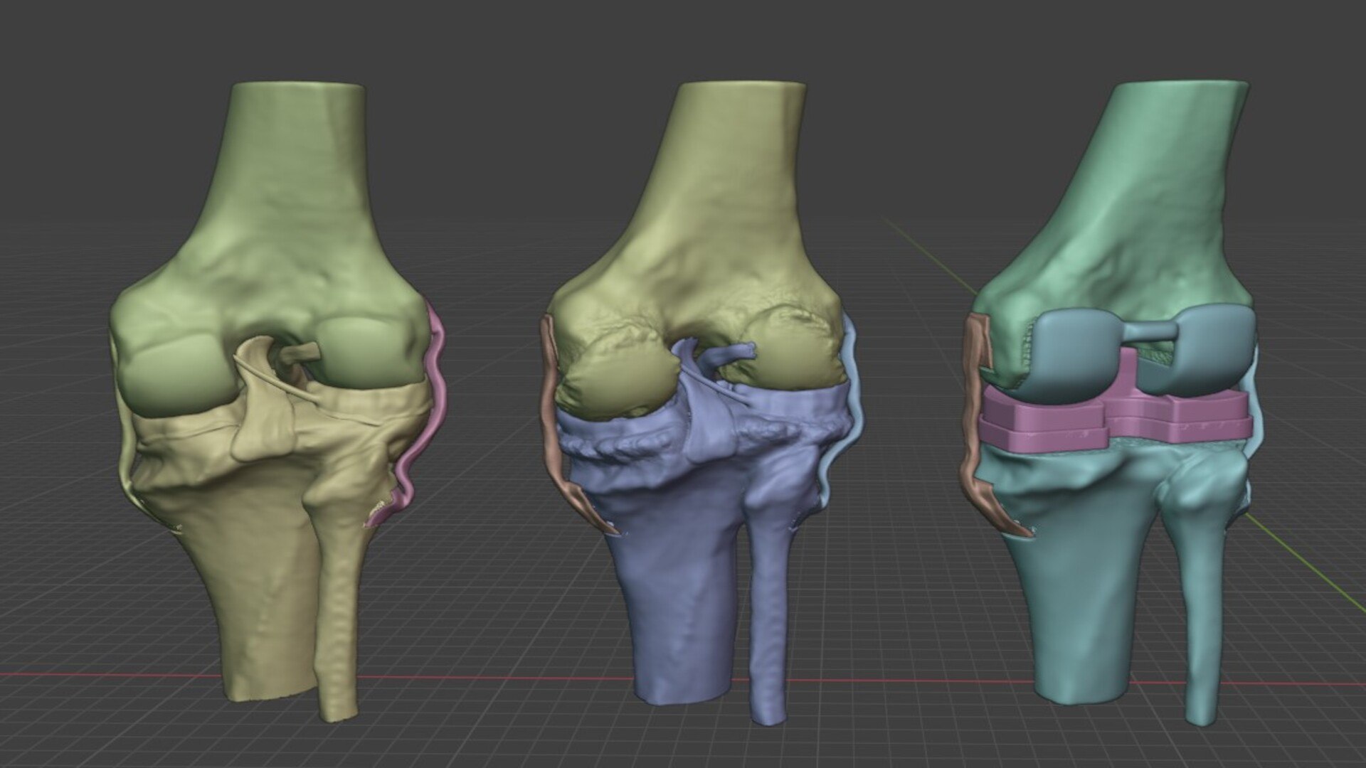 Modular 3D Knee Study Model Model - TurboSquid 2536450