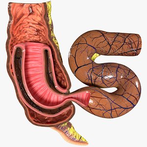 Intussusception intestine ileocolic obstruction 3D
