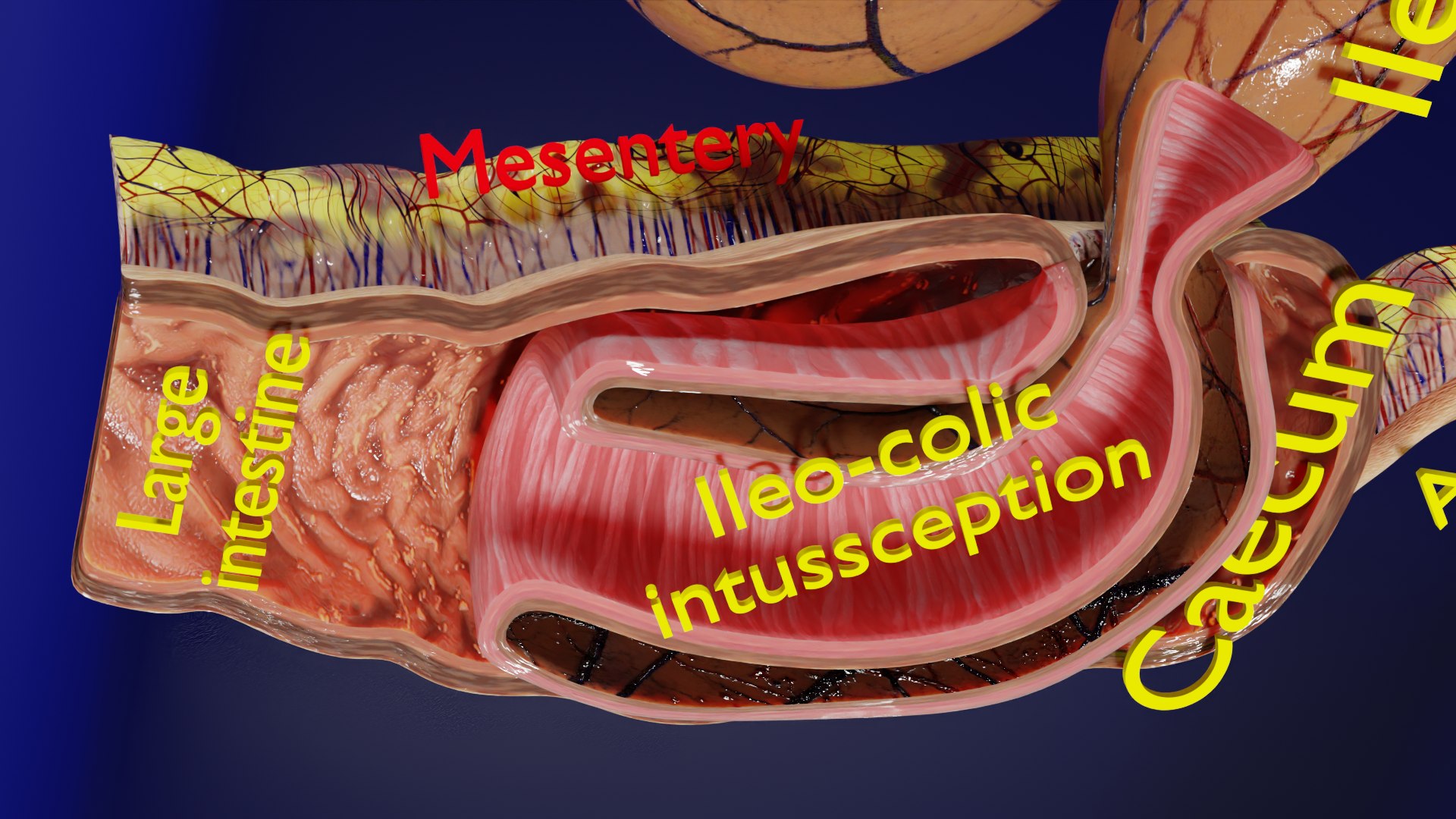 Intussusception Intestine Ileocolic Obstruction 3D - TurboSquid 2414944