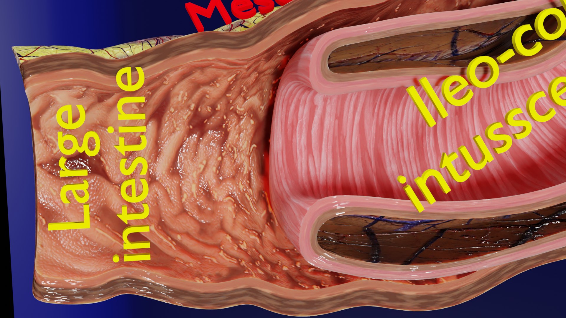 Intussusception Intestine Ileocolic Obstruction 3D - TurboSquid 2414944