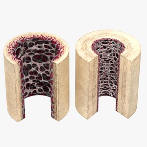 3D Healthy and osteoporotic Bone section