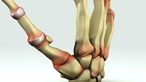 Rheumatoid Arthritis