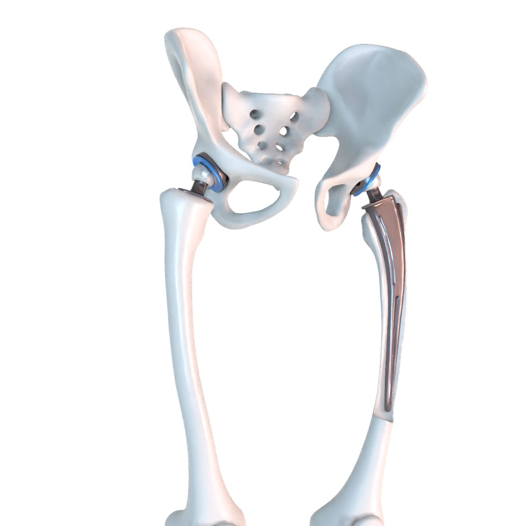 Hip replacement implant installed model - TurboSquid 1507568