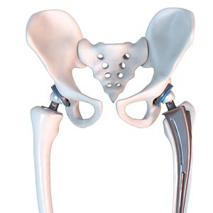 Hip replacement implant installed in the pelvis bone
