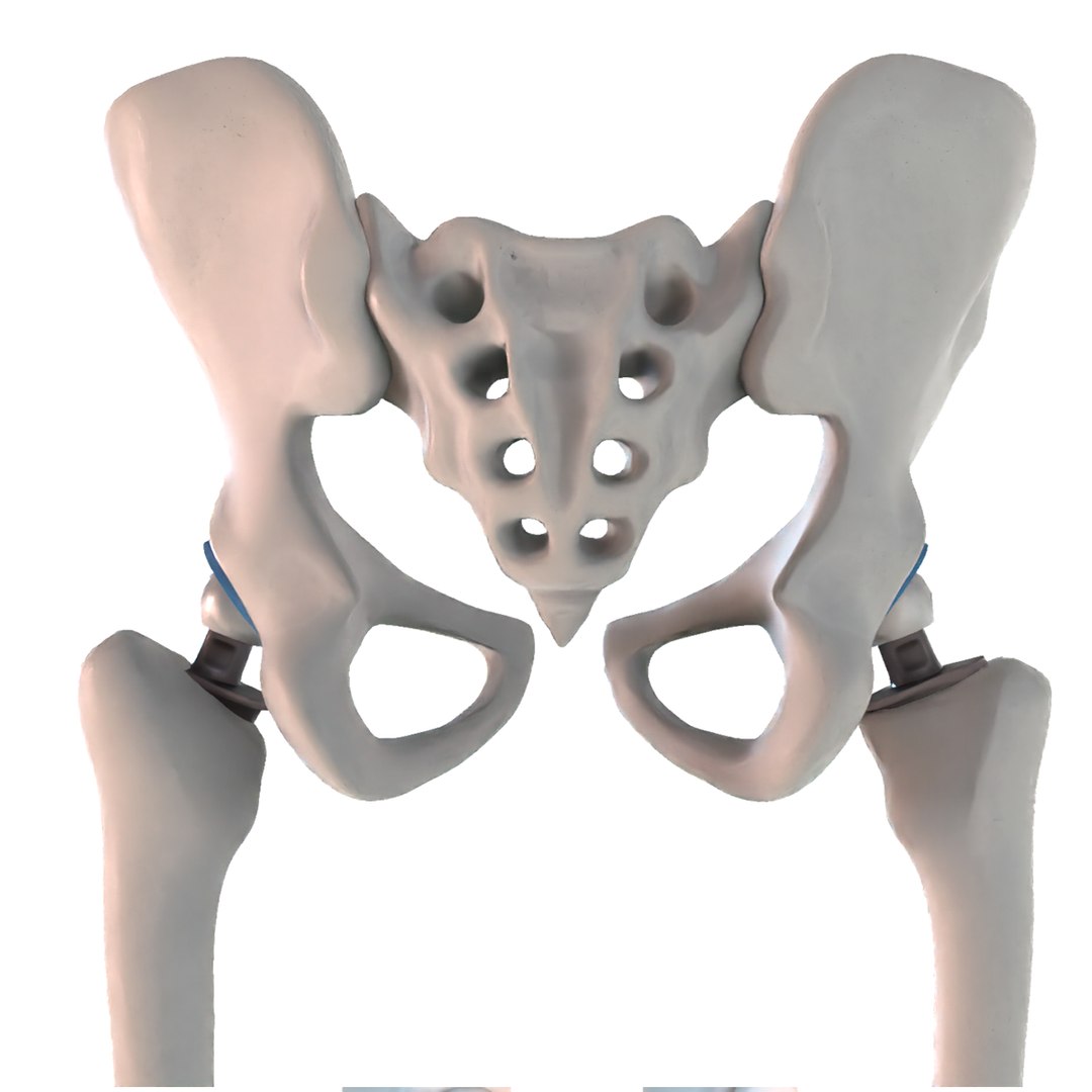 Hip Replacement Implant Installed Model Turbosquid 1507568