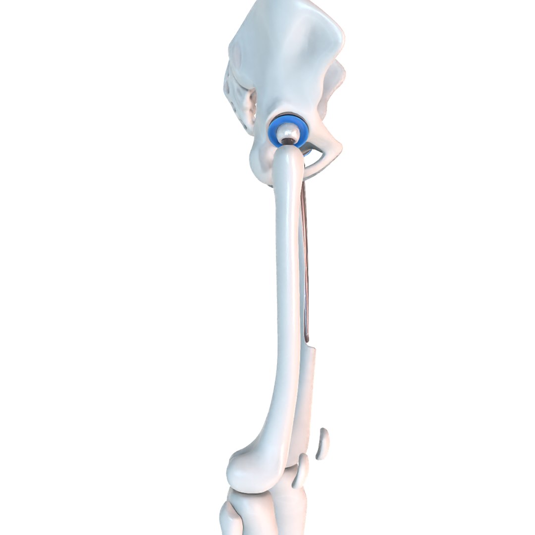 Hip Replacement Implant Installed Model - Turbosquid 1507568