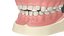 Dental Anatomy Educational Pediatric Kit with Removable Open Bite Teeth