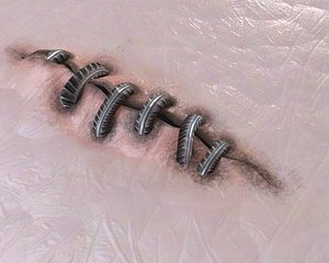 Scar