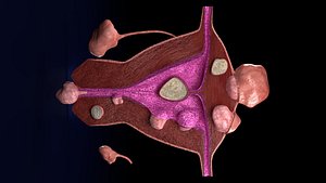 Fibroid Uterus Human female 3D model