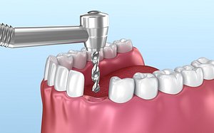 dental implant instalation animation 3D model