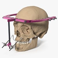 Cranial External Distractor Attached to Skull Pink