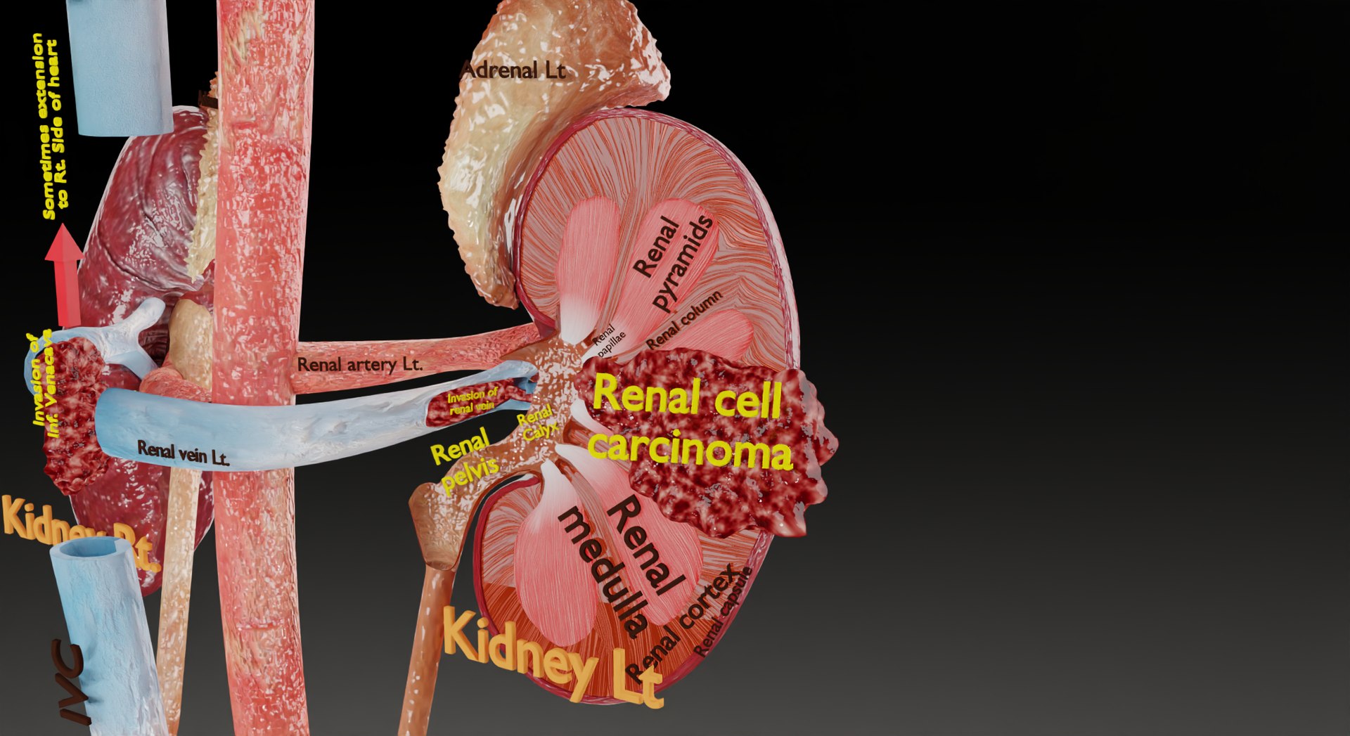 Renal cell carcinoma 3D model - TurboSquid 1980618