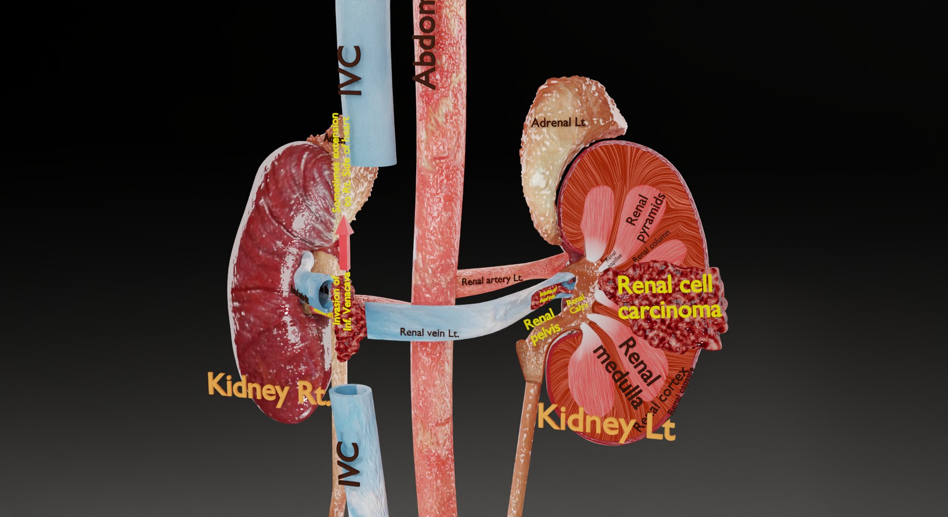 Renal Cell Carcinoma 3D Model - TurboSquid 1980618