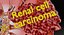 Renal cell carcinoma 3D model