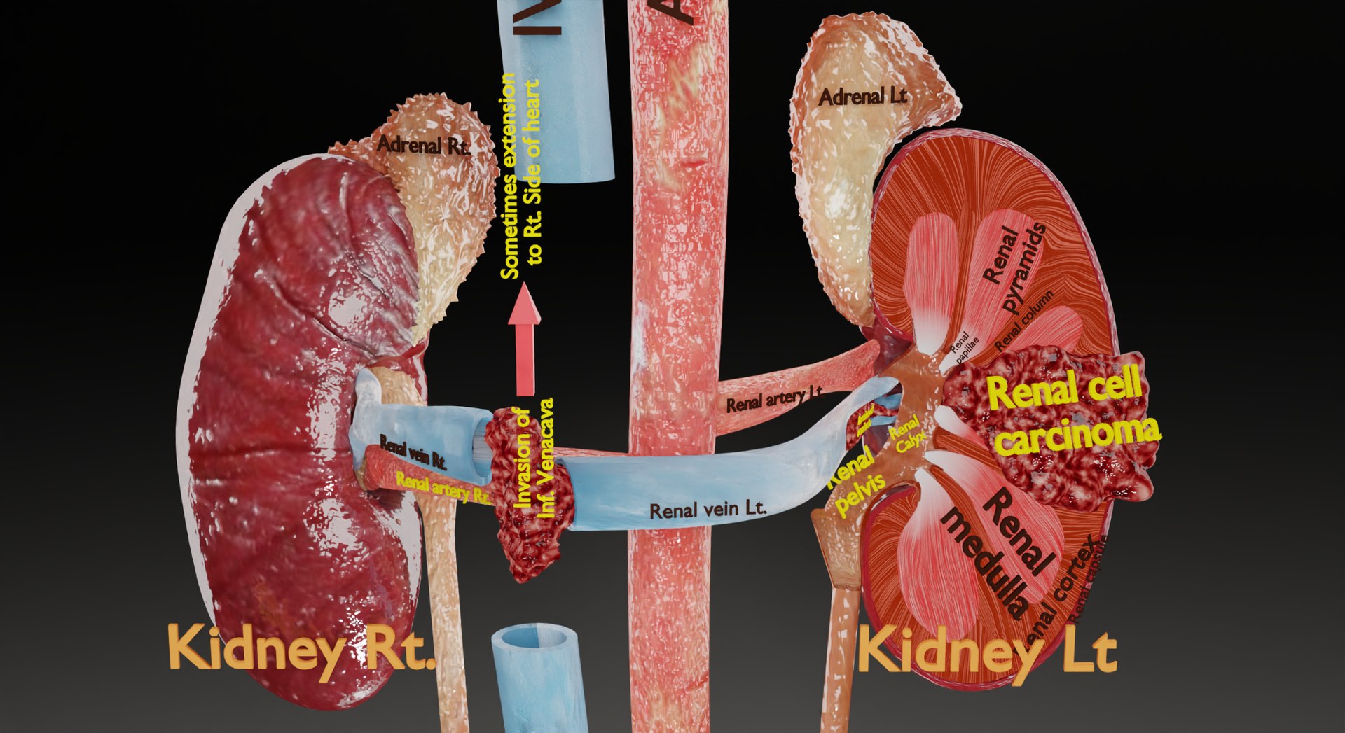 Renal Cell Carcinoma 3D Model - TurboSquid 1980618