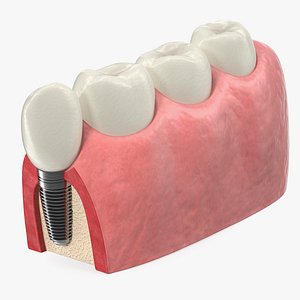 3D model education tooth implant modeled