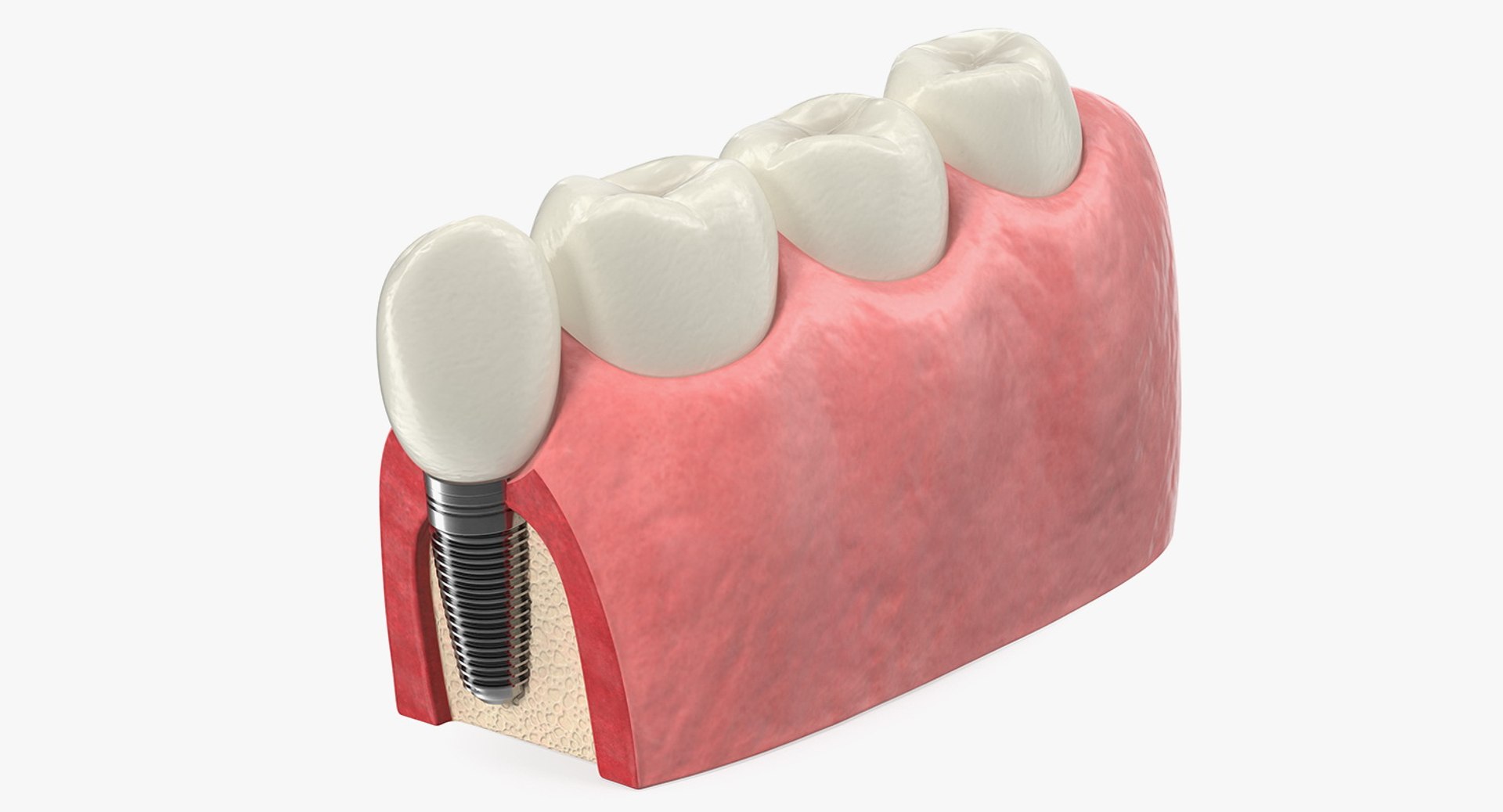 Dental Collection 4 3D model preview