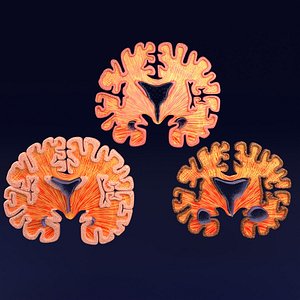 Alzheimer Disease Brain coronal slice 3D model