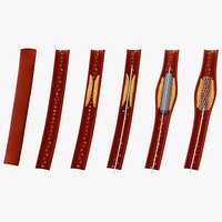 Coronary Stent  Angioplasty Anatomy - 6 Stage Medical Procedure