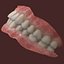 Dentures