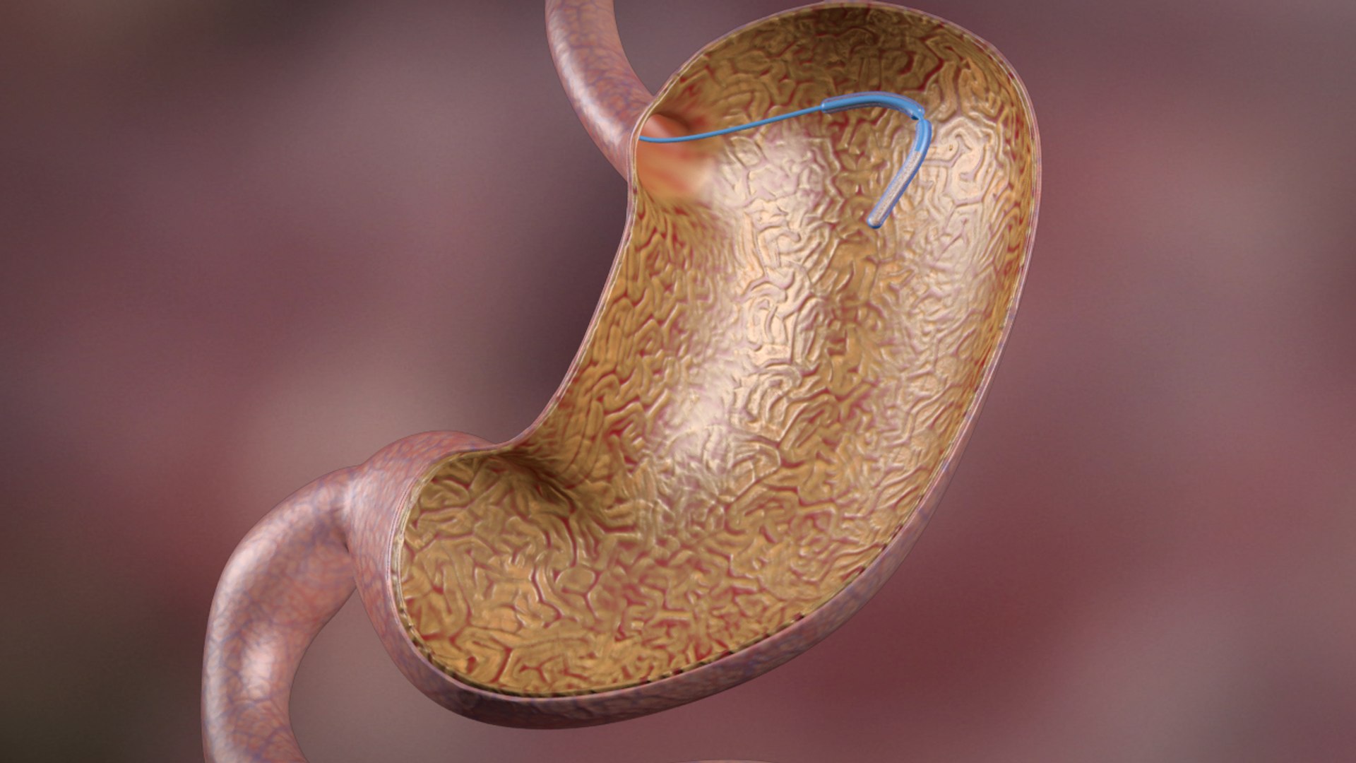 3d balloon gastric https://p.turbosquid.com/ts-thumb/l2/Hp7nhR/IbgzdJyB/ball_00001/jpg/1462409069/1920x1080/fit_q87/f88f03205329f854e668e45d8c94033a05f30f03/ball_00001.jpg
