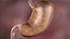 Gastric Balloon