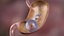 Gastric Balloon