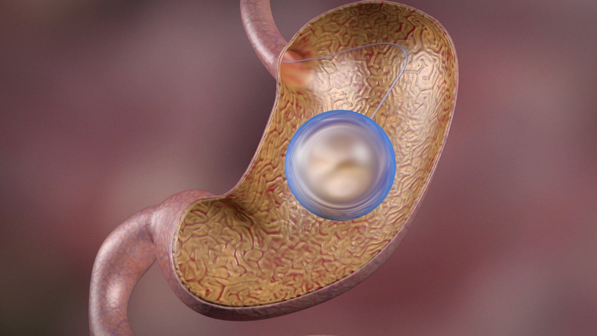 3d balloon gastric https://p.turbosquid.com/ts-thumb/l2/Hp7nhR/MXNGYNeS/ball_00005/jpg/1462409069/1920x1080/fit_q87/d1ed0a2b7f28ad99617461effb85e67cd217b966/ball_00005.jpg
