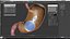 Gastric Balloon