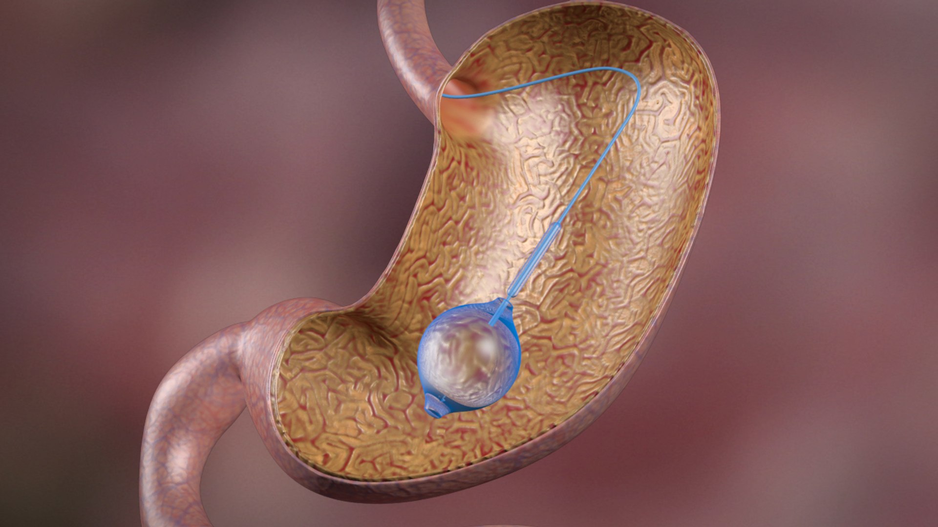 3d balloon gastric https://p.turbosquid.com/ts-thumb/l2/Hp7nhR/jzzLQvqH/ball_00002/jpg/1462409069/1920x1080/fit_q87/e7b48b9d300c4e4536e707a84afdbd61740e18df/ball_00002.jpg