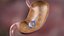 Gastric Balloon