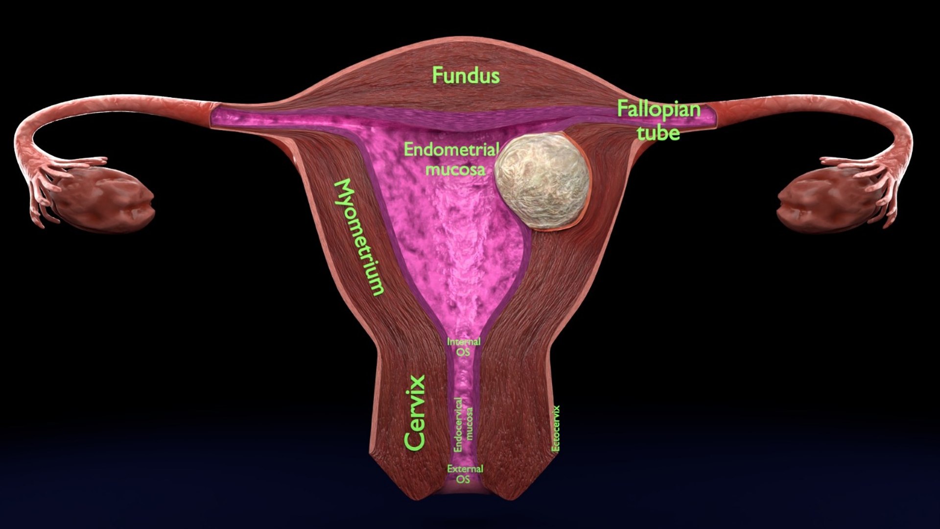 Uterus normal versus  fibroid types 3d set 3D model https://p.turbosquid.com/ts-thumb/l5/FHKntk/16/whatsappimage20260209at20.00.37/jpeg/1770829642/1920x1080/fit_q87/95b1489df509e486f0016a89d3f8e148df15b022/whatsappimage20260209at20.00.37.jpg