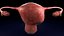 Conjunto 3D de tipos de útero normal versus fibromas