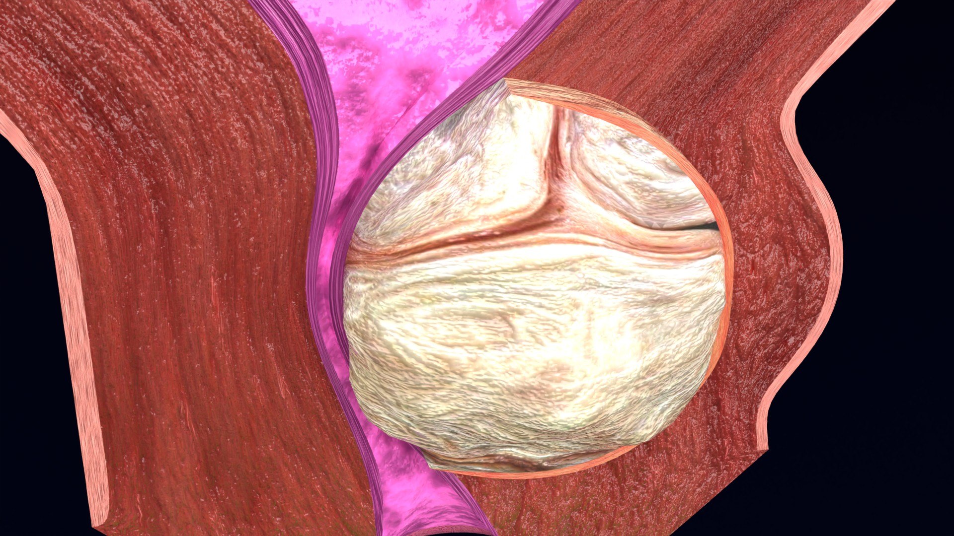 Uterus normal versus  fibroid types 3d set 3D model https://p.turbosquid.com/ts-thumb/l5/FHKntk/21/cerv0002/jpg/1770829606/1920x1080/fit_q87/d5c45e9e7c622a2fbe3d11a31d8ff7349bc23385/cerv0002.jpg