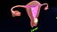 Conjunto 3D de tipos de útero normal versus fibromas