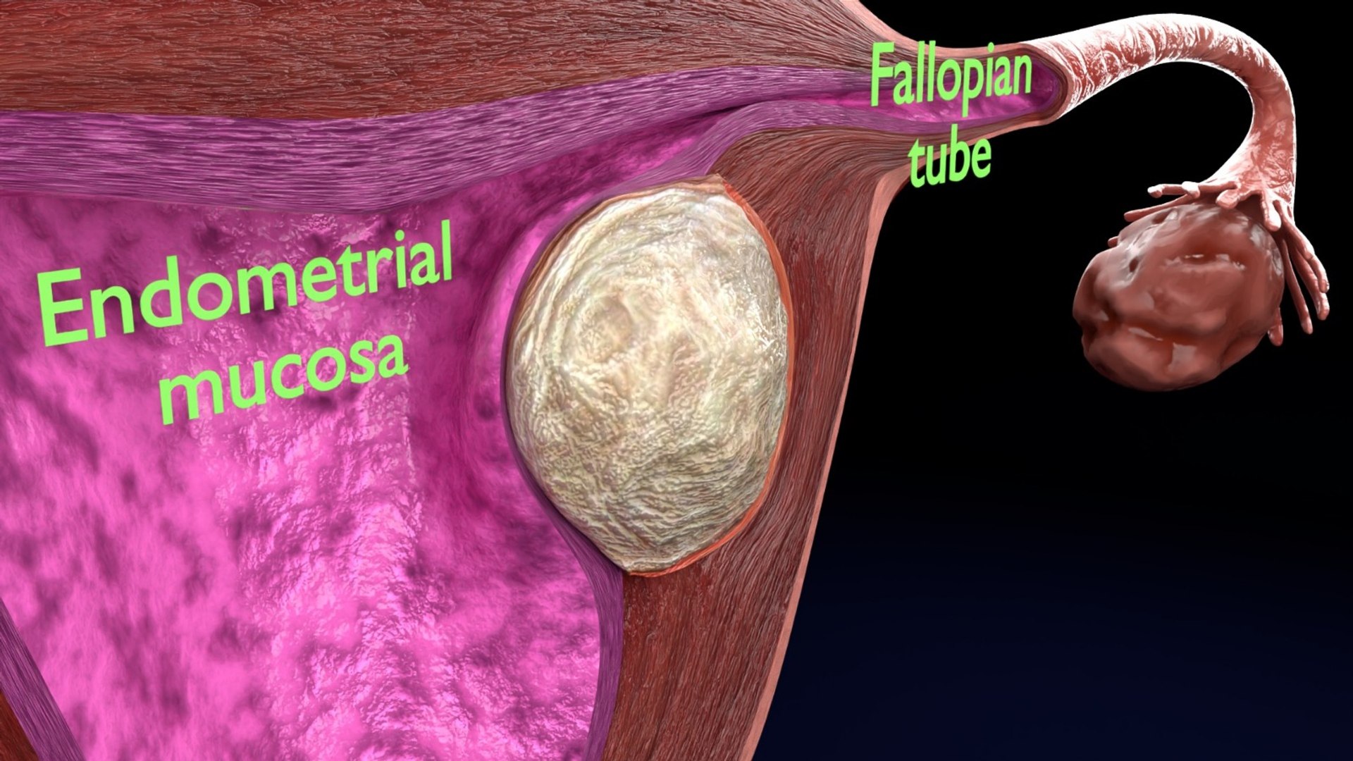 Uterus normal versus  fibroid types 3d set 3D model https://p.turbosquid.com/ts-thumb/l5/FHKntk/6N/1/jpeg/1770829642/1920x1080/fit_q87/569c5024ffee1c4dcd320f8e49b36ce269b08503/1.jpg