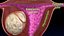 Conjunto 3D de tipos de útero normal versus fibromas