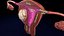 Conjunto 3D de tipos de útero normal versus fibromas