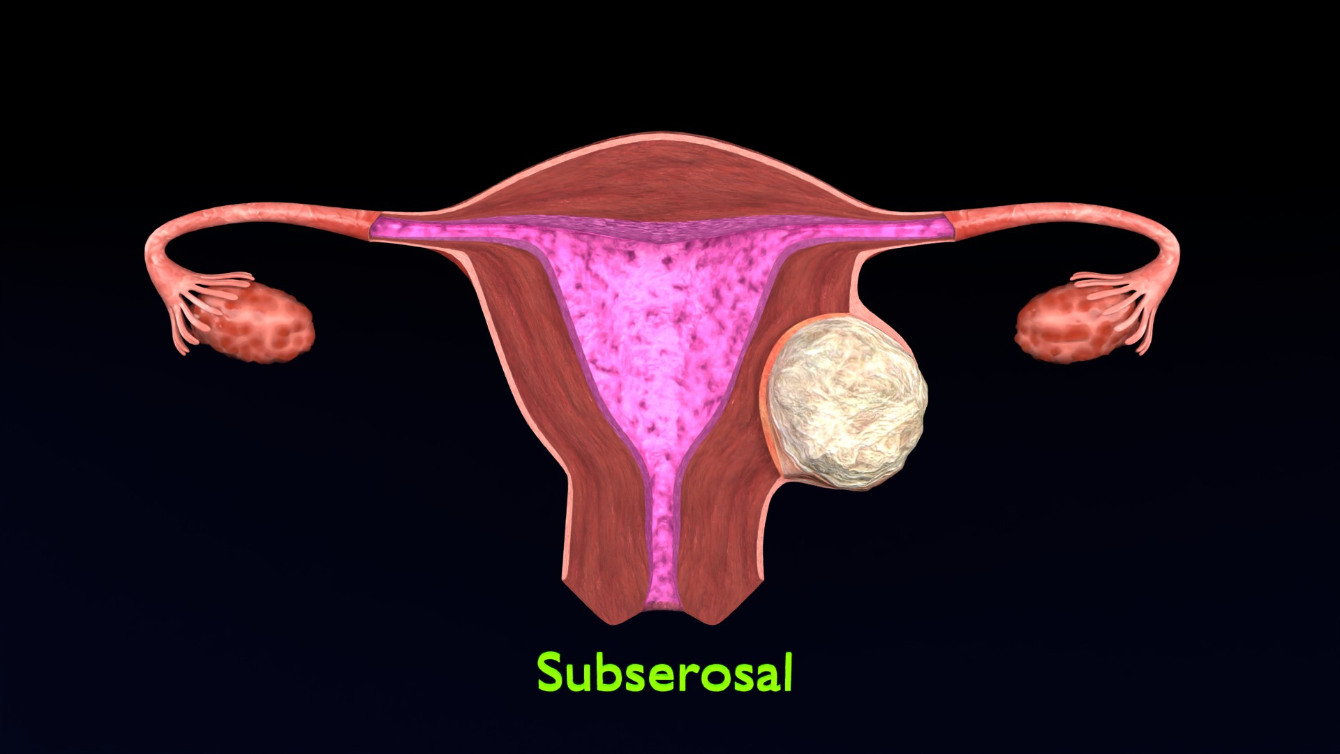 Uterus normal versus  fibroid types 3d set 3D model https://p.turbosquid.com/ts-thumb/l5/FHKntk/Lm/seroimage/jpg/1770829778/1920x1080/turn_fit_q99/fa9446d4f54cb66896a7e01288f8b7684ebe3bf0/seroimage-1.jpg