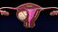 Conjunto 3D de tipos de útero normal versus fibromas