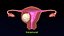 Conjunto 3D de tipos de útero normal versus fibromas