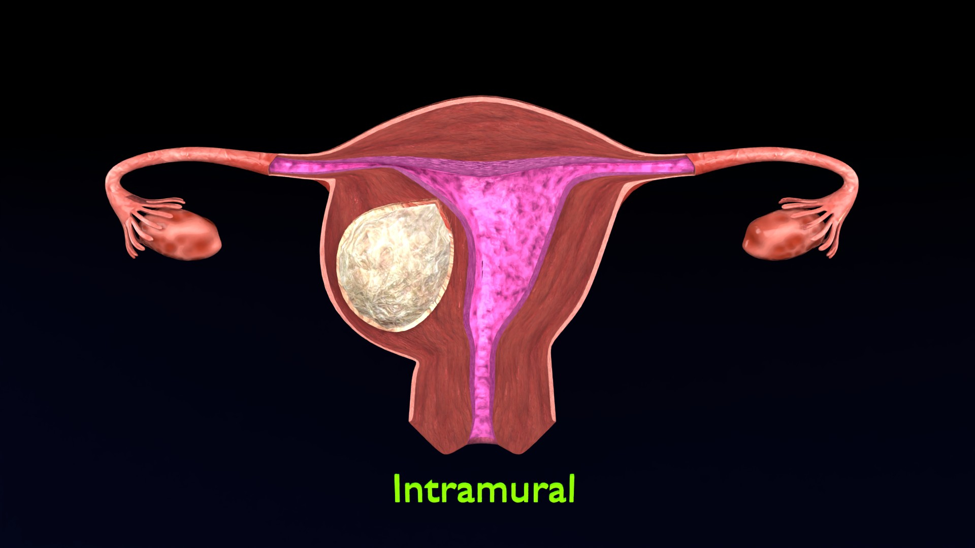 Uterus normal versus  fibroid types 3d set 3D model https://p.turbosquid.com/ts-thumb/l5/FHKntk/aD/intimage/jpg/1770829742/1920x1080/turn_fit_q99/9ffb12a82bc5606f0e86104a0ef5d68d73083fc0/intimage-1.jpg