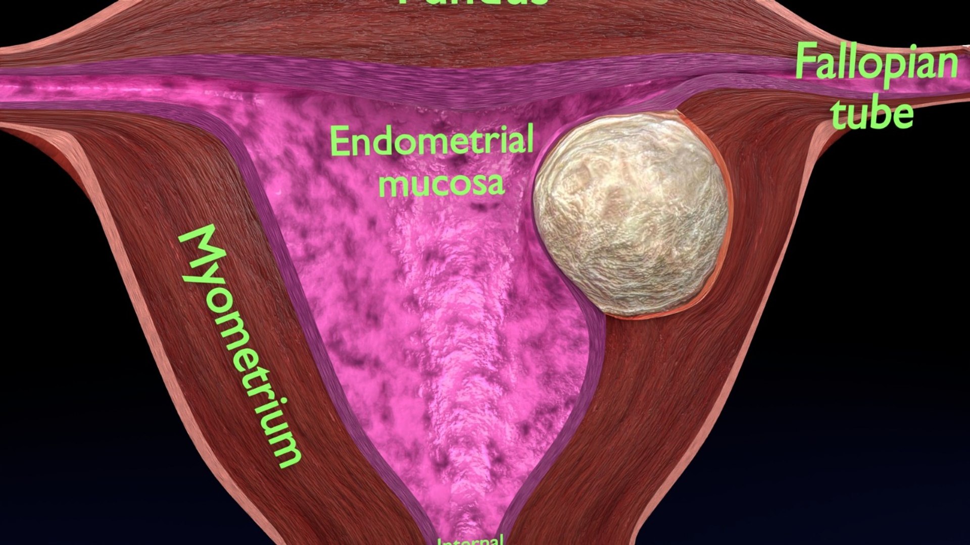 Uterus normal versus  fibroid types 3d set 3D model https://p.turbosquid.com/ts-thumb/l5/FHKntk/ck/2/jpeg/1770829643/1920x1080/fit_q87/f7f9d0688b9166c85e18b30d285d6b58937ff83a/2.jpg