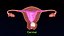 Conjunto 3D de tipos de útero normal versus fibromas