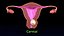 Conjunto 3D de tipos de útero normal versus fibromas