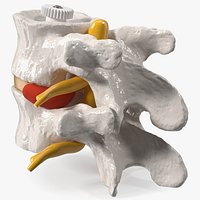 Part of Spinal Column with Hernia