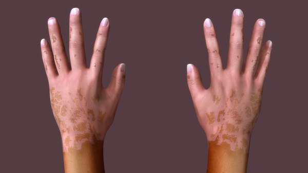 modelo 3d Vitiligo Leucoderma enfermedad de la piel - TurboSquid 2184626